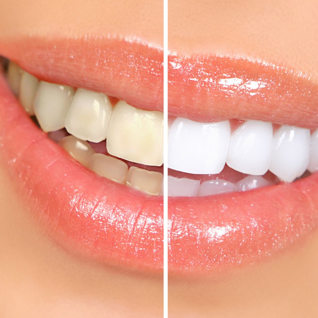 Un Sourire Éclatant : Ce Que Vous Devez Savoir sur le Blanchiment Dentaire