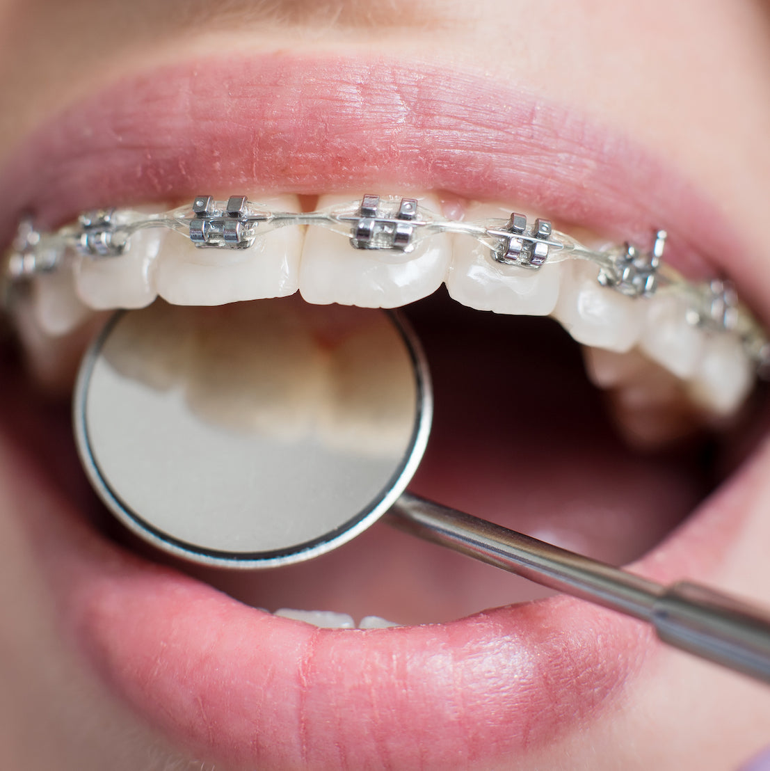 Orthodontie pour enfants au cabinet dentaire du Dr Meryam Mamouni à Rabat