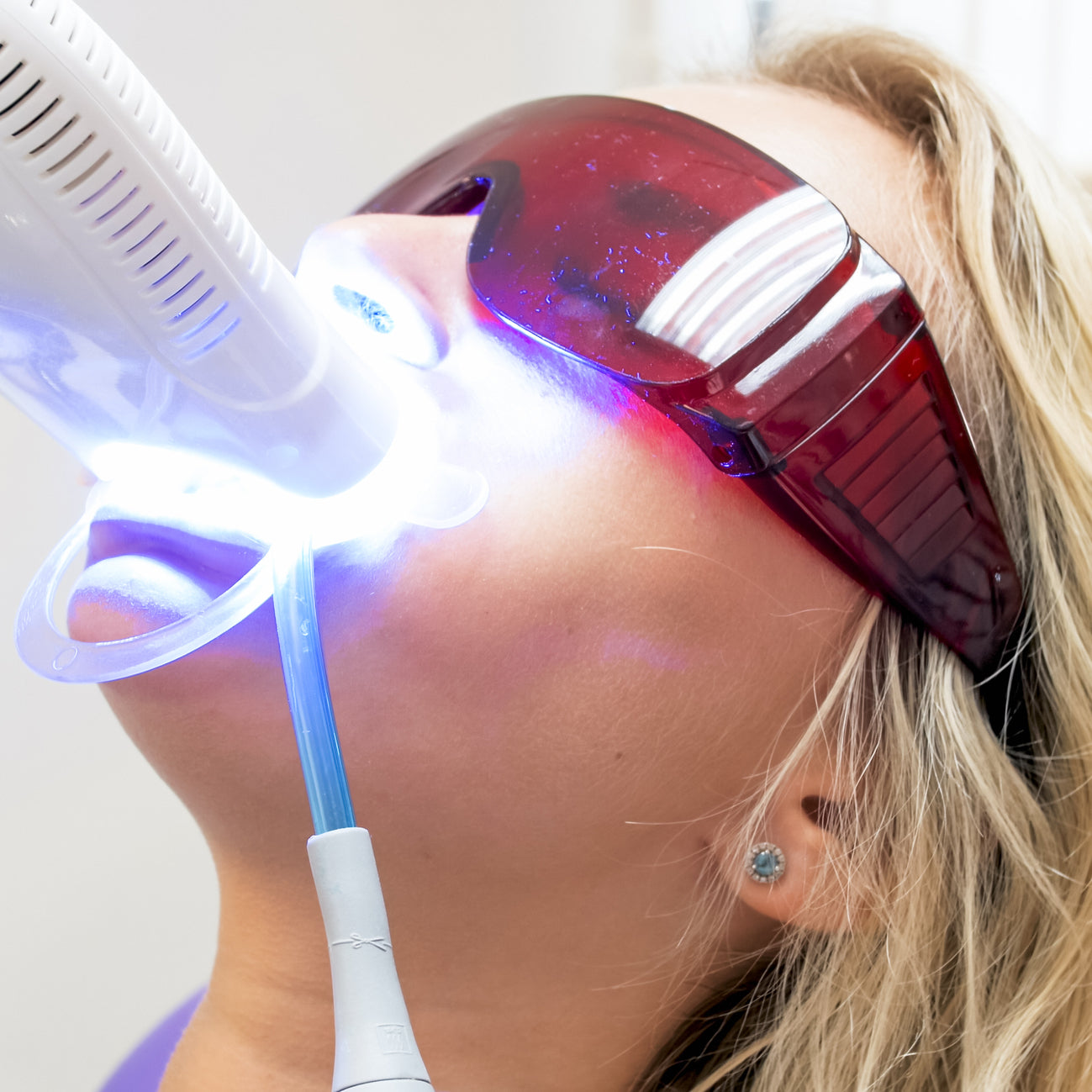 Opération de blanchiment dentaire au fauteuil réalisé au cabinet du Dr Meryam Mamouni à Rabat