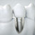 Implant Dentaire à Rabat