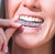 Traitement Orthodontique Invsisalign réalisé au cabinet dentaire du Dr Meryam Mamouni à Rabat