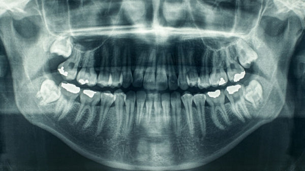 RADIOGRAPHIE PANORAMIQUE